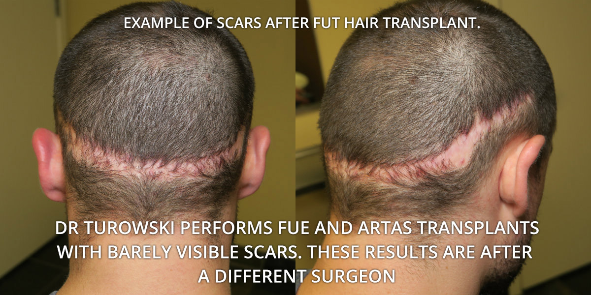 FUT Hair Transplant Before After Photos And Results